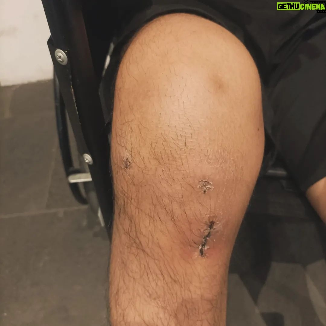 Emmanuel Roman Morales - 7.2K Likes - El día de ayer me quitaron los puntos y el vendaje comenzamos rehabilitación 🙏