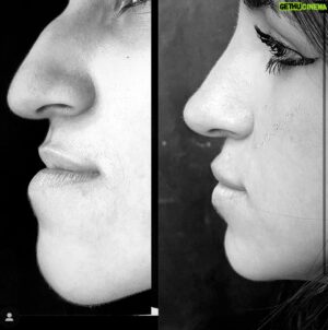 Felipe Torres Instagram - E aí meooo?! Faço uma rinoplastia tb?