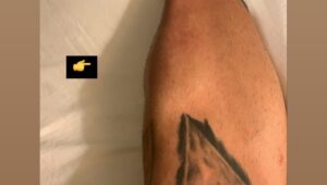 Guido Cannetti Instagram - Me dicen no pelees Guido dio 5 libras más es mucha ventaja yo todo deshidratado digo al mananger deciles que peleo pero que le paguen más y así me quedó la tibia, por qué el pibe estando 5 kilos más, aguanto todo. Esto me recuerda al bálsamo de @puravida_oildrops que me ayudó a drenar la inflamación y recuperar mi pierna #CBD #PuraVida