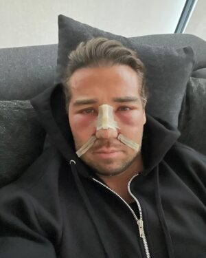 James Lock Instagram - @serenecosmetic_  surgery dump so far! Swipe to see what my face looked like before and parts of my journey thanks for your help after my accident on set 🙌🏼 Message @serenecosmetic_ with all enquiries. 

1. After being given the green light to fly home post surgery
2. Chill time in the hospital, my own private room
3. The recovery villa, the perfect place to heal
4. Insight into my hospital room, with the best nurses always on hand to help
5. Food is included which makes life a lot easier, the staff here couldn’t be more helpful
6. My face before my surgery which some people may have seen
7. Only 2 days post op, swollen but still feeling good! 
8. Just over 2 weeks after surgery 🙌🏽
-
 @comfortzonesurgeryofficial the surgery provider.