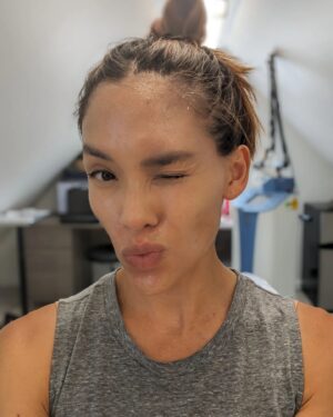Jessalyn Wanlim Instagram - No filters and going on 41! Thank you @toyosclinicaesthetics for round 2 of #mixtolaser resurfacing treatment. I've gotten so many compliments on my skin and now we're just working on some stubborn acne scars 🤍
1. 15 minutes after treatment (and barely any redness at that!)
2. Waiting for numbing cream to do its work
3. Immediately after my mixto session
4. Dr. Melissa did my hands too since I have massive insecurities there🙈
.
.
.
.
#antiaging #laserresurfacing #nashville #medspa #laserresurfacingtreatment #mixto