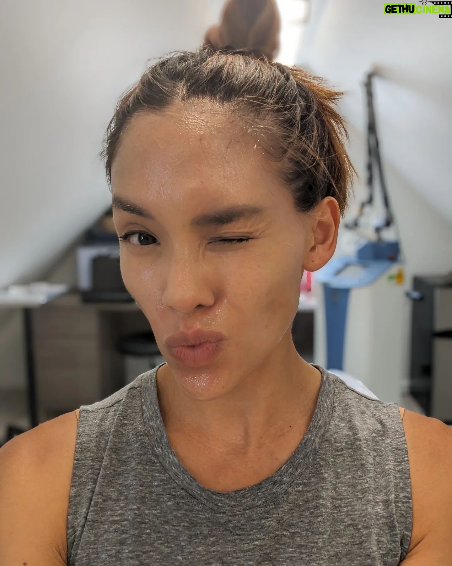 Jessalyn Wanlim - 3 Likes - No filters and going on 41! Thank you @toyosclinicaesthetics for round 2 of #mixtolaser resurfacing treatment. I've gotten so many compliments on my skin and now we're just working on some stubborn acne scars š¤
1. 15 minutes after treatment (and barely any redness at that!)
2. Waiting for numbing cream to do its work
3. Immediately after my mixto session
4. Dr. Melissa did my hands too since I have massive insecurities thereš
.
.
.
.
#antiaging #laserresurfacing #nashville #medspa #laserresurfacingtreatment #mixto