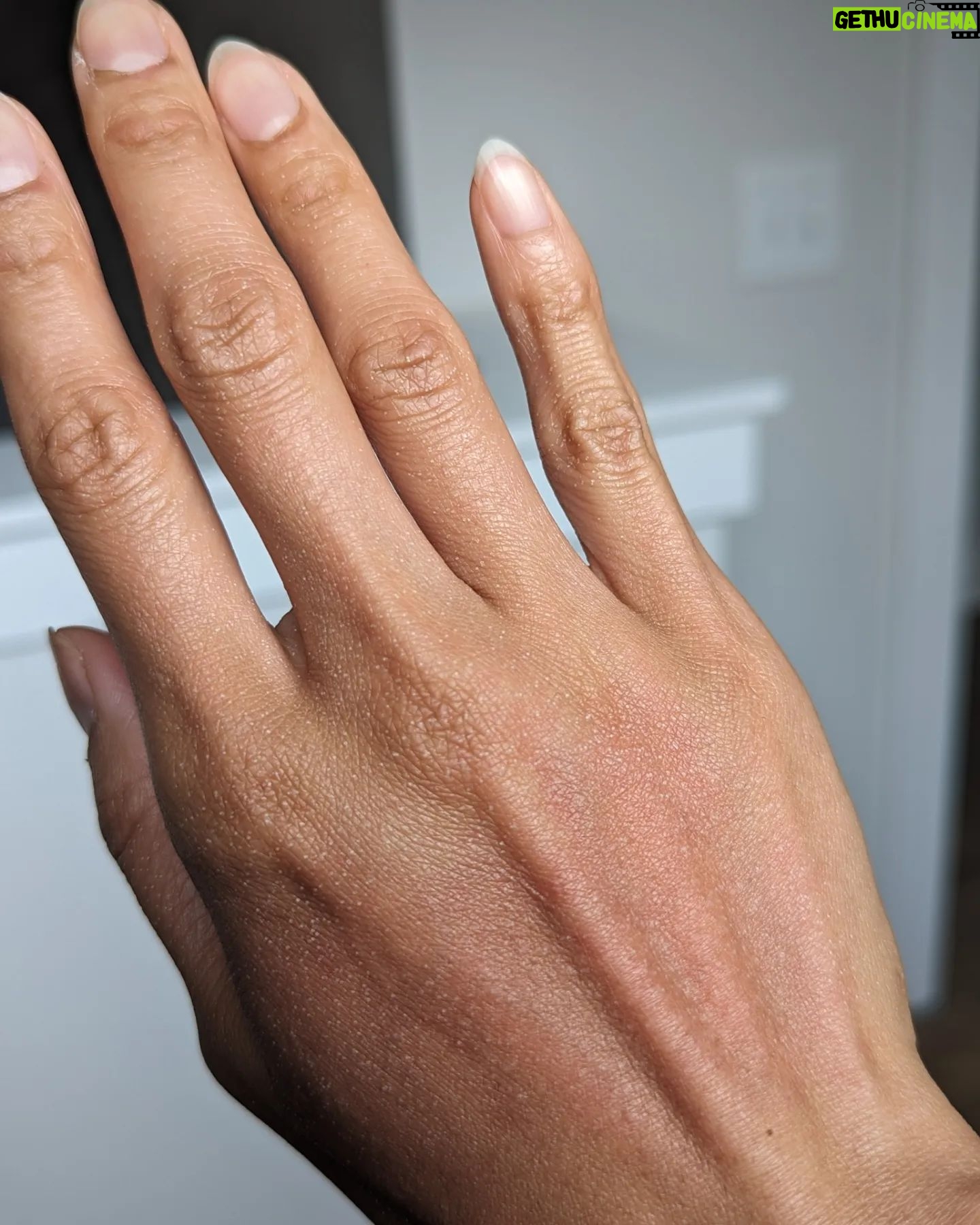 Jessalyn Wanlim - 3 Likes - No filters and going on 41! Thank you @toyosclinicaesthetics for round 2 of #mixtolaser resurfacing treatment. I've gotten so many compliments on my skin and now we're just working on some stubborn acne scars š¤
1. 15 minutes after treatment (and barely any redness at that!)
2. Waiting for numbing cream to do its work
3. Immediately after my mixto session
4. Dr. Melissa did my hands too since I have massive insecurities thereš
.
.
.
.
#antiaging #laserresurfacing #nashville #medspa #laserresurfacingtreatment #mixto