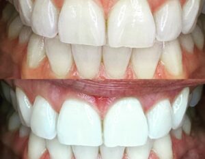 Jewels Jaselle Instagram - Feeling absolutely gleaming after my visit to 'We Whiten'! 🌟 I stepped in with a smile and stepped out with a sparkle! Teeth whitening turned out to be not just about beauty, but relaxation too - it was like a spa day but for my teeth. 🦷✨ I can't wait to wow with my luminous smile at the next outing! Check out my before and after shots, and you'll see why I'm already looking forward to my next session! 😁 #WeWhiten #RadiantSmile #TeethWhiteningGlowUp #ad
Swipe ➡️ to see the transformation.  Book your appointment today click on the link for special discounts http://mytime.com/u/RTDXp