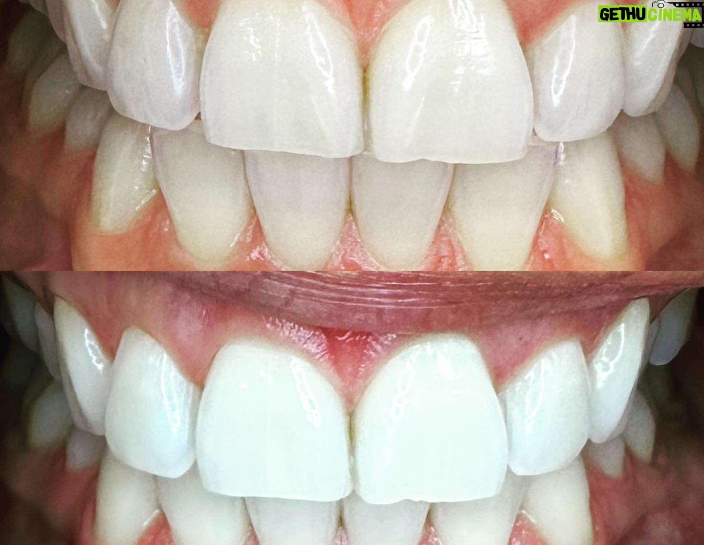 Jewels Jaselle - 121 Likes - Feeling absolutely gleaming after my visit to 'We Whiten'! 🌟 I stepped in with a smile and stepped out with a sparkle! Teeth whitening turned out to be not just about beauty, but relaxation too - it was like a spa day but for my teeth. 🦷✨ I can't wait to wow with my luminous smile at the next outing! Check out my before and after shots, and you'll see why I'm already looking forward to my next session! 😁 #WeWhiten #RadiantSmile #TeethWhiteningGlowUp #ad
Swipe ➡️ to see the transformation. Book your appointment today click on the link for special discounts http://mytime.com/u/RTDXp