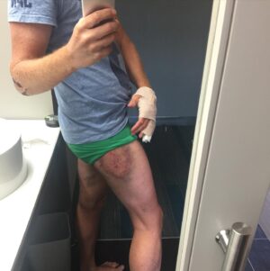Måns Möller Instagram - Ibland cyklar jag omkull (bild från USA 2015) men trots gipsad hand ,brutna fingrar o spruckna revben brukar jag gå i mål! ”Mitt Perfekta Liv” har premiär ikväll. Det har varit en lång resa - teknikstrul gjorde att jag ”cyklade omkull” på vägen - men tillslut i Falun o Mjölby på provföreställningarna satt det o nu är jag redo 🚀🚀🚀Wish me luck 💯 #allafårvamed