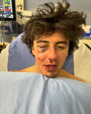 Mark McMorris Instagram - What I thought was a black eye turned out to be a more severe injury. On Monday, I underwent surgery at VGH to have my orbital bone and nose repaired. Dr. Brown and his team did a stellar job, and I’m now officially on the mend. Thank you all for the kind messages and healing vibes! It means a lot❤️ Most of all, thank you to all of my partners who have had my back through this! @redbull @burton @oakley @nike @redbullcanada @burtonsnowboards