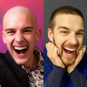 Matthew Patrick Instagram - Day 1 vs Day 30. 
After raising over 1 Million Dollars in less than 10 hours during our charity livestream for St. Jude, I promised to shave my head AND grow a beard for the first time in my life! From Cue Ball to Fur Ball, it's crazy what a difference a month can make. #baldpat #beard #stjude #gametheory