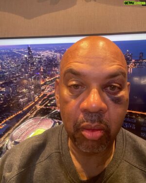 Michael Wilbon Instagram - How’d I do @miketyson ? I’d like to say you should see the other guy, or in this case the other guy is an angry piece of Tumi luggage (my own) and the asphalt tarmac at Scottsdale Airport…

Thanks to my brilliant makeup artists Deanna Jordan in Az and Mattie Wagner in LA for making my left eye pretty…back to 100 percent soon…