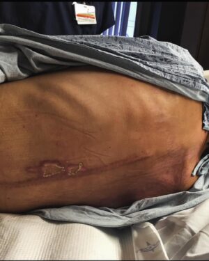 Quinn Brett Instagram - Flat on my back with a newly anointed #spinalcordinjury I scoured the internet absorbing whatever I could to educate myself, my family, my friends, and in turn the instagram world about SCIs. 

Like you, I was shocked my quadzillas were no longer able to stomp up hill but the stark reality of not feeling when my bladder was full, now having to stick a finger in my ass to initiate a poop and an incessant burning sensation in my lower half.  #neuropathicpain 

What drugs are you giving me and why?  Why did it take 5 days until my spinal stabilization surgery?  Why is my whole lower half tingling?  Is this really how far we have come in the wheelchair business and overall neurological disorder research?  I was confused, angry, disappointed and grasping for educated voices.

I found @u2fp — a growing non-profit organization based in my childhood stomping grounds of Minneapolis.  They had published a book and I am still AWE struck that although it is FREE on Amazon that it is NOT stock piled at EVERY rehab hospital.  Search - “Don’t Call It a Miracle”  Download it.  Read it.  Thanks. 🤙🏼

I found their podcast— The CureCast.  Link in my Bio.  Start listening, go back to the first episodes to learn about the SCIENCE of what is HAPPENING in my spinal column.  You will have a better understanding that my spinal cord IS INDEED NOT completely severed.  I have a dime sized bruise that is blocked up with cells that intended to heal and instead created a nasty environment in which signals don’t get across, or do for some on a mixed sort of way. 🪢

I learned, I am not a hopeless cause.  I may never run again but fixing my bladder or feeling a hand on my thigh are useful recovery of function research that IS ongoing AND IN HUMAN CLINICAL TRIALS because of U2FP’s extensive work. ❤️

All this to say, I have taken a full-time position as the Development Director with U2FP.  I want to amplify our message of restorative function in paralysis through advocacy, education, and support for research. 

I strongly believe it is not impossible.  Every person should have equal access to treatments that will restore health and independence after spinal cord injury. #impossibleisnothing