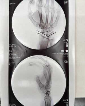 Rodolfo Vieira Instagram - Acabei de fazer uma cirurgia no punho direito…Vou contar a história aqui de como tudo aconteceu.

Eu já estava com uma lesão a mais de 5 meses que mesmo cuidando eu não via melhora, quando faltava 1 mês para minha última luta eu acertei um soco na manopla e acabei piorando ainda mais, meu último mês de treino foi tenso, até infiltração eu tentei (algo que eu nunca tinha feito na vida) para aliviar a dor que eu tava sentindo e não via melhora. Naquele momento eu percebi que a lesão era bem séria, mas eu não quis fazer exame até pq eu estava disposto a lutar de qualquer forma mesmo que fosse entrar lá só pra perder, mas graças a Deus ganhei😂 Falando um pouco da luta, o que me deixou confiante era saber que mesmo limitado eu ainda tava conseguindo fazer jiu jitsu, que era como eu estava acreditando que ia ganhar…

 Quando cheguei no Brasil corri para fazer os exames e descobri que eu tinha rompido um ligamento do meu punho, e eu não podia marcar logo a cirurgia devido aos seminários que eu tinha pra fazer, então tive que esperar até hoje…Quero agradecer ao Dr André Teixeira, a sua equipe pelo suporte e atenção comigo desde o primeiro dia e a Clínica São Vicente pela ótima hospitalidade e atendimento. Agora é muito repouso, cuidado e cair dentro da fisioterapia para melhorar o mais rápido possível… obrigado a todas as mensagens que recebi. Está tudo bem!
