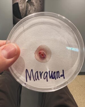 Ross Marquand Instagram - Well folks, I finally decided to listen- to family, friends, and fans. Countless people told me to get my nose checked over the past four years and I always said I was too busy and couldn't possibly find the time...which was partially true. My schedule has been absolutely bonkers for longer than I can remember. But guess what? I let this problem fester and it grew into cancer...and left unchecked it could've become much, much worse. 
I hesitate to share this because I'm usually a very private person but I'm posting this to encourage all of you to prioritize your health - be that physical, mental, or emotional. I clearly did not, and now I'm playing catch up. Hopefully I'll have many more days to learn and grow- to be healthier, to be better...but nothing in this life is certain. 
Get yourself sorted and please don't wait like I did. Lots of love to everyone for their kind words of support and encouragement, happy holidays, and oh yeah... #fuckcancer 🏥