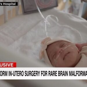 Sanjay Gupta Instagram - An exclusive story about baby Denver. She had a rare, potentially life-threatening brain abnormality, and a team at Boston Children’s Hospital and Brigham and Women’s Hospital was able to successfully treat her. The most amazing part: Denver hadn’t even been born yet. Watch this remarkable —first-of-its-kind — procedure.