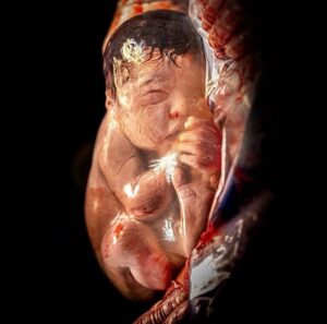 Sherry A. Ross Instagram - A stunning photo of a C-section En Caul Birth! This is also known as a ‘veiled birth’ and refers to when baby is born within their intact amniotic sac. #fotofriday 

📸: @antonuccifotografia