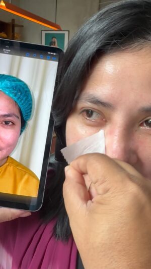 Tompi Instagram - Hr 10 post Rhinoplasty iga
Dalam 3-6 bulan , akan semakin ramping …