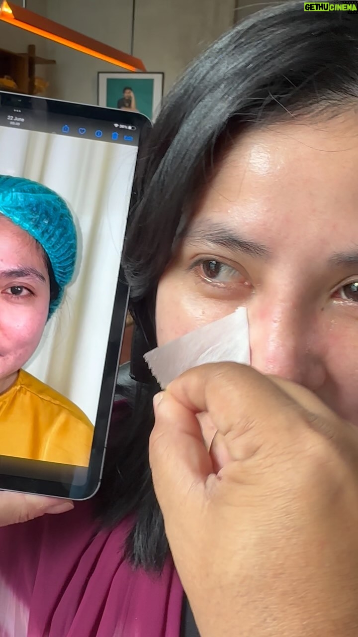 Tompi - 3.4K Likes - Hr 10 post Rhinoplasty iga
Dalam 3-6 bulan , akan semakin ramping …