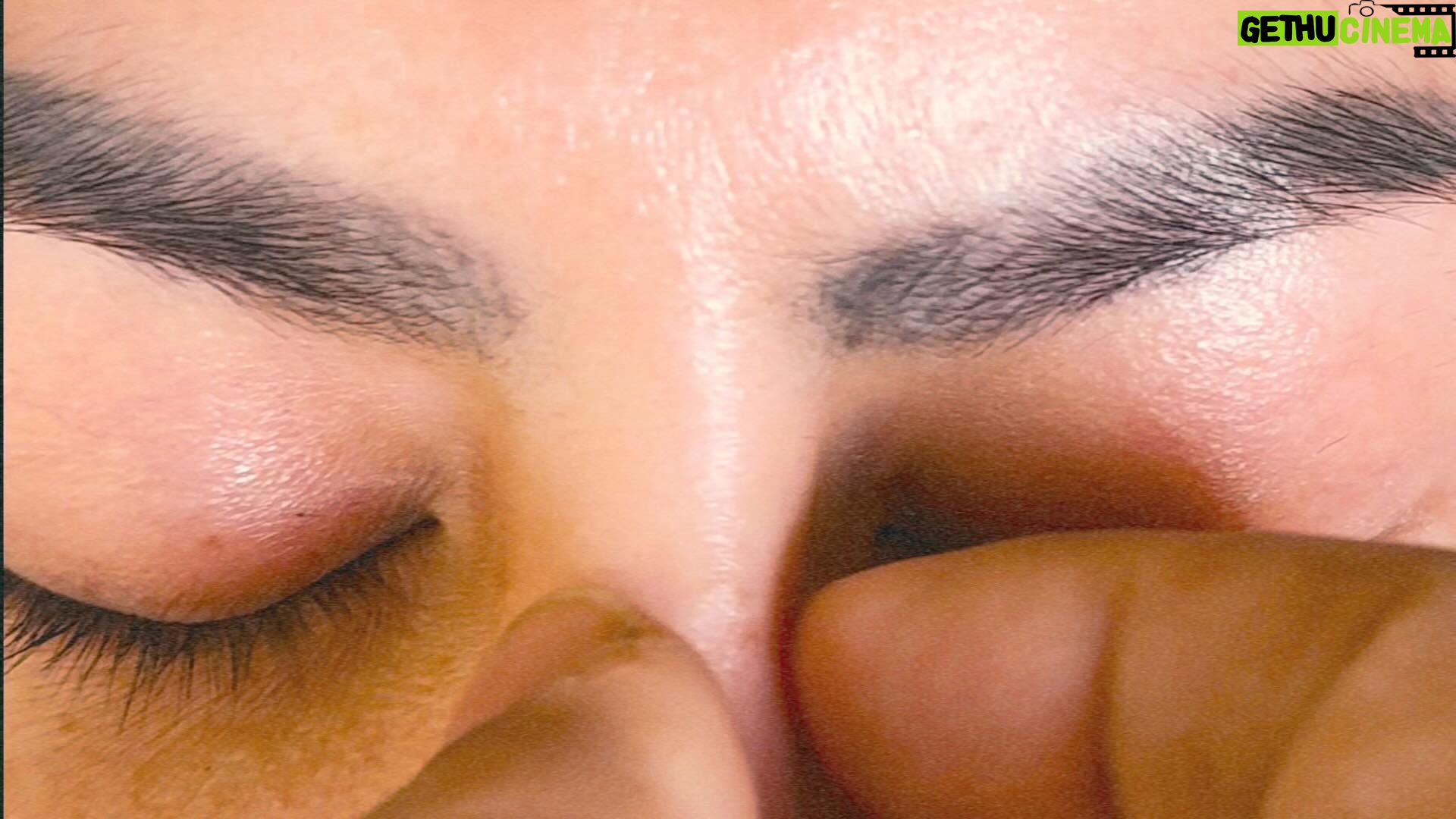 Tompi - 2.3K Likes - Rhinoplasty today ; koreksi implant miring dan ngejiplak. Itu implantnya bs digerak2an krn penempatannya dibawah kulit. Seharusnya dibawah periosteum jd lbh terfiksir.
Di video bagian akhr tampak sudah dilakukan koreksi Dengan Rhinoplasty iga