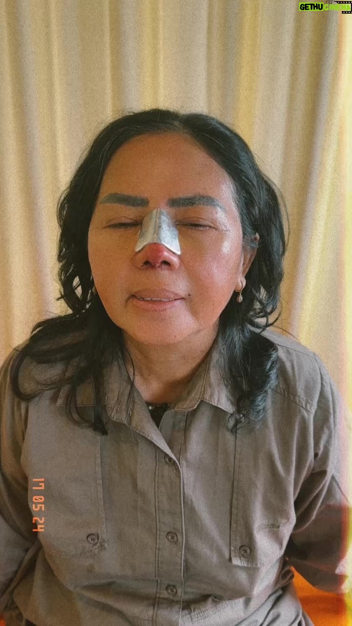 Tompi - 2.1K Likes - Kontrol hr 4 rhinoplasty iga