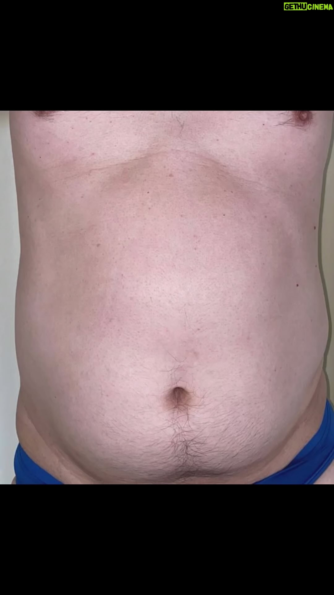 Tompi - 6K Likes - Perut buncit : perlu dinilai kelebihan lemak, kelemahan otot dan kelebihan kulit. Tummytuck dengan liposuctio perlu dilakukan utk memperbaikinya. Bye2 buncit…