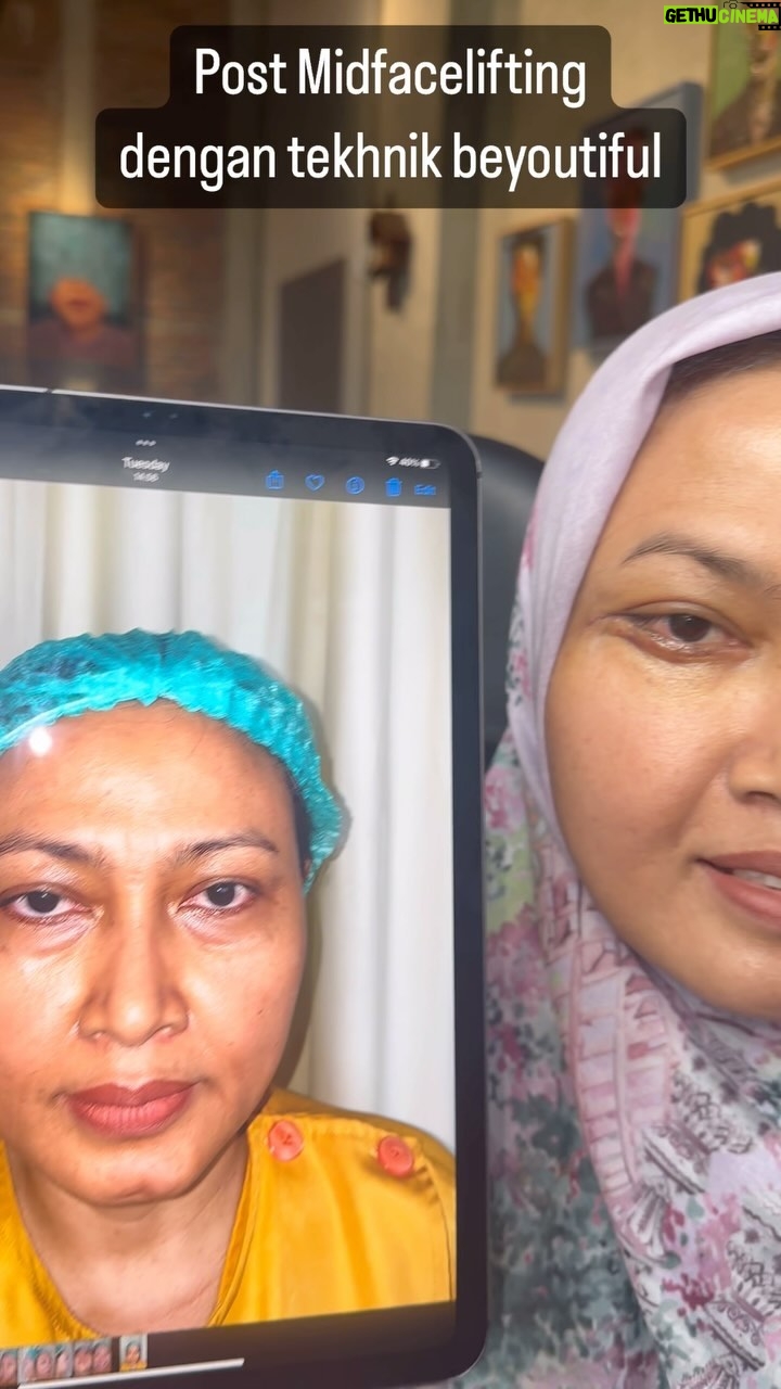 Tompi - 1.2K Likes - Koreksi kantung mata ala BEYOUTIFUL , dengan tekhnik midfacelifting yg sy kembangkan dan sudah bs dikerjakan disemua cabang @beyoutifulbydrtompi
Op dengan sedasi ringan, gak sakit sama sekali
Post op sangat nyaman , bisa lansung mandi cuci wajah sabunan make up pake Kacamata bahkan olahraga.
Ini contoh case post op hari ke 6 saatnya cabut jaitan, bengkak memar minimal dan tak hanya kantung mata hilang rata, juga terbentuk aegyo sal dengan menggunakan otot sendiri ( bukan filler y) dan area tengah wajah naik jd terkesan bervolume dan lebih muda. Biasanya sebulan juga dah cakepan kok, dan perfectnya 3-6 bln
INGAT : area bawah mata jangan dibuang lemaknya supaya TDK CEKUNG nantinya dan JANGAN DI FILLER2 krn akan berjendul
BEYOUTIFUL T-SPACE BINTARO9 telp 0811 8111 0558 0811 8111 0559
BEYOUTIFUL PAKUBUWONO jl PAKUBUWONO VI no 5a jaksel 62 821-1303-5099 0217211025