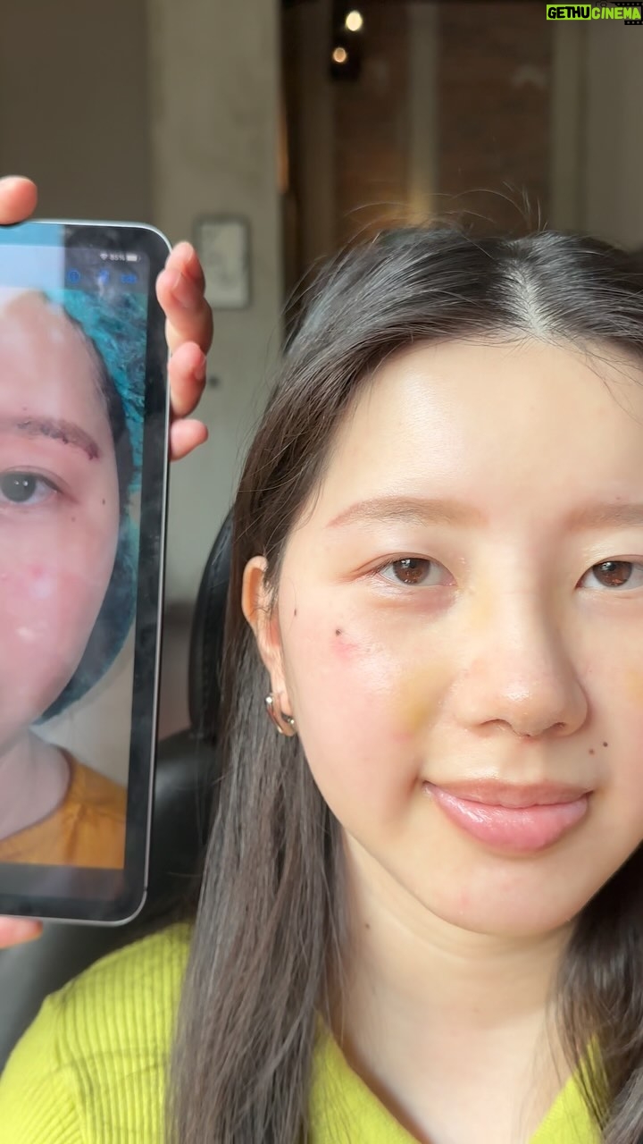 Tompi - 1.3K Likes - Tampilan hari ke 12 post Rhinoplasty iga, meniruskan pipi dan sedikit memajukan dagunya. Pasien ingin hasil yg “tdk berlebihan— maunya sangat natural”
JANGAN LUPA HARI MINGGU tgl 23 juni 2024, sy akan visit JOGJA
Mau op apa disana??