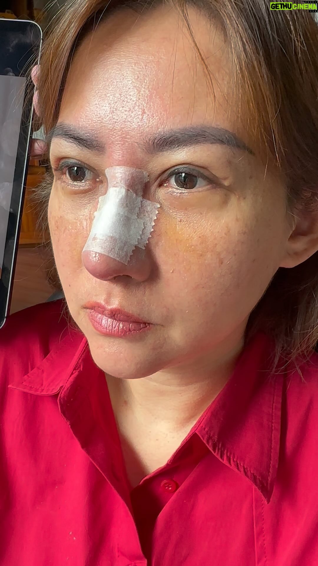 Tompi - 1K Likes - 12 hari post op mata atas bawah dan rhino iga