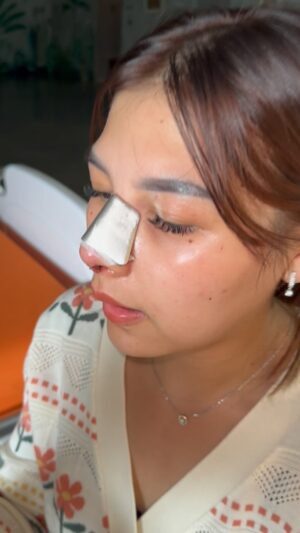 Tompi Instagram - Hari ke 3 post op rhinoplasty iga, saatnya buka cast. 
Kl dibandingkan dengan hasil segera setelah op, tampak bengkak minimal sekali, memar nyaris gak ada.

Permasalahan sebelum op: tip bulky,hidung agak pendek, dan ada deviasi septum