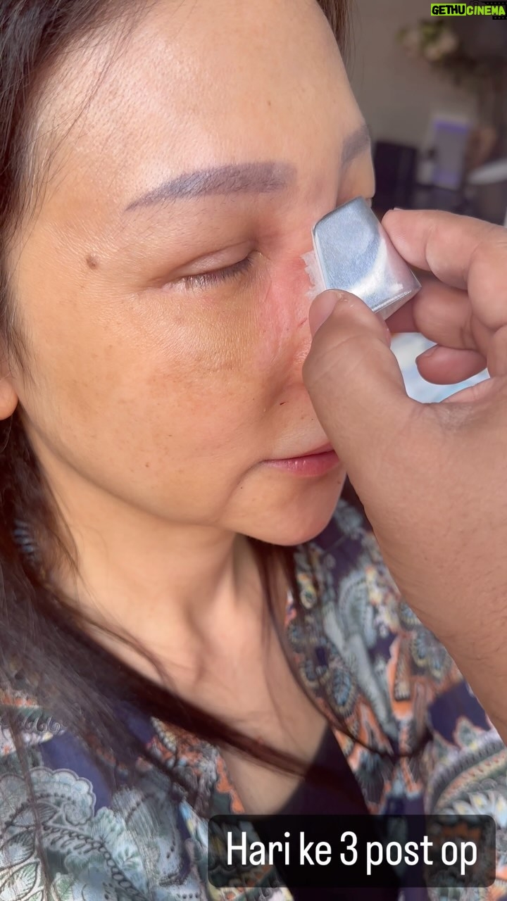 Tompi - 1.9K Likes - Saatnya lepas balutan hidung hari 3 post Rhinoplasty iga, case short nose dan deviasi septum