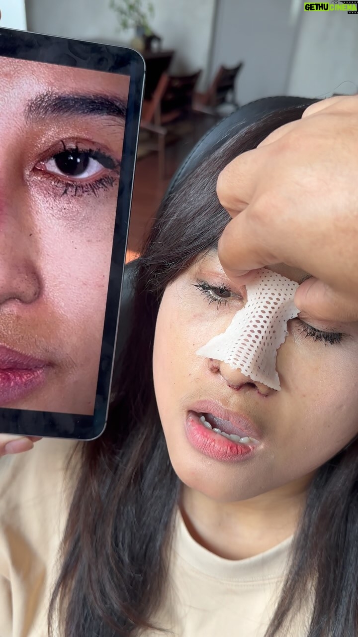 Tompi - 1.7K Likes - Hr 3 post Rhinoplasty iga koreksi dengan riwayat op berulang sebelumnya (7x) di @beyoutiful.aesthetic Insyallah hasilnya baik sembuh dengan cepat