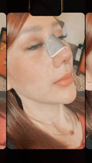 Tompi Instagram - Hari 10 post Rhinoplasty iga
Akan semakin ramping dalam 3-6 bulan