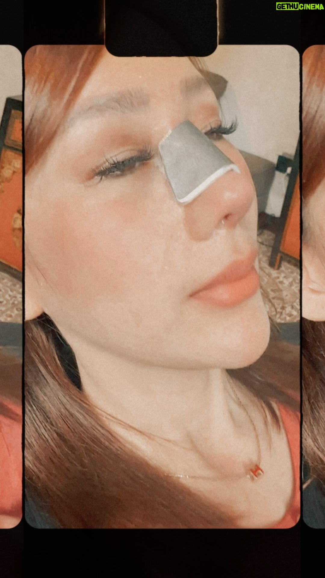 Tompi - 1K Likes - Hari 10 post Rhinoplasty iga
Akan semakin ramping dalam 3-6 bulan