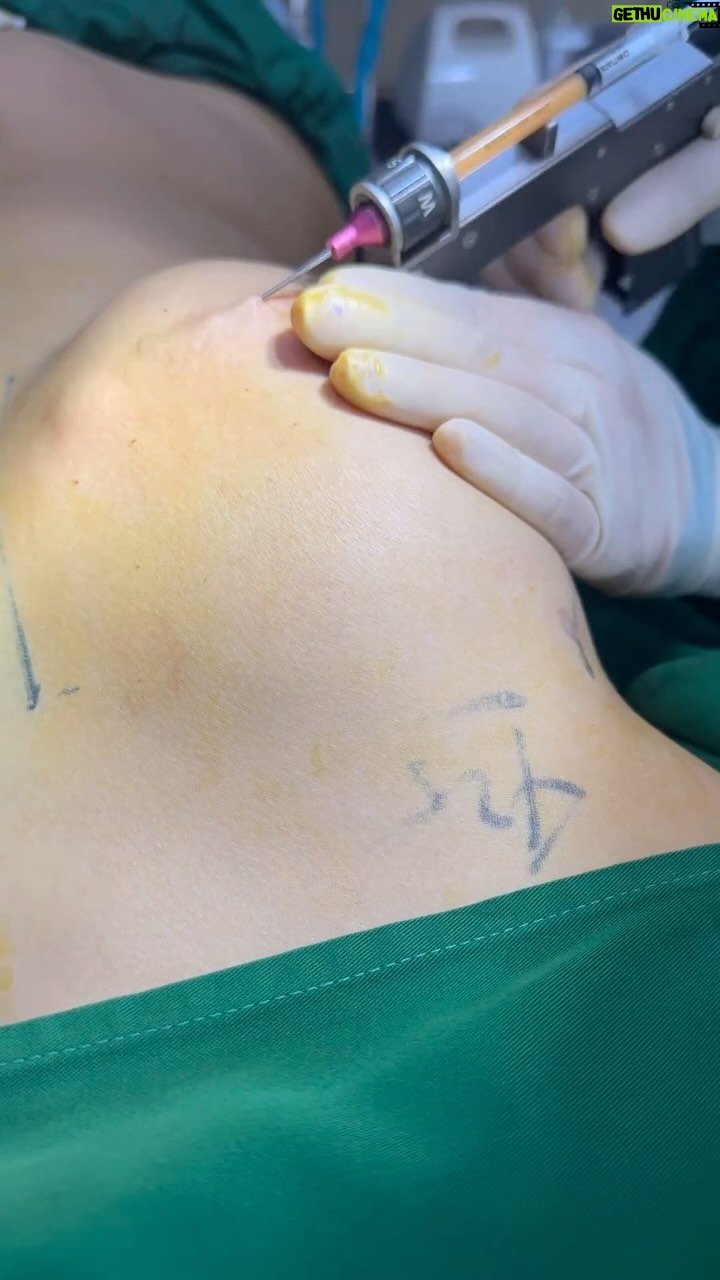 Tompi - 4K Likes - BEYOUTIFUL Breast augmentation HYBRID dengan dual plane IMPLANT dan final touch dengan FAT TRANSFER utk mendapatkan hasil yg lbh NATURAL dan KEREN. Bulan ini ada 20% khusus utk breast surgery.
Op 1.5 jam
Bius tidur (sedasi ringan)
Tdk rawat inap—- PULANG
Bisa lansung beraktifitas senyamannya
Korset 1 bulanan
BEYOUTIFUL T-SPACE BINTARO9
telp 0811 8111 0558 0811 8111 0559
@BEYOUTIFUL PAKUBUWONO
jl PAKUBUWONO VI no 5a jaksel
62 821-1303-5099 0217211025