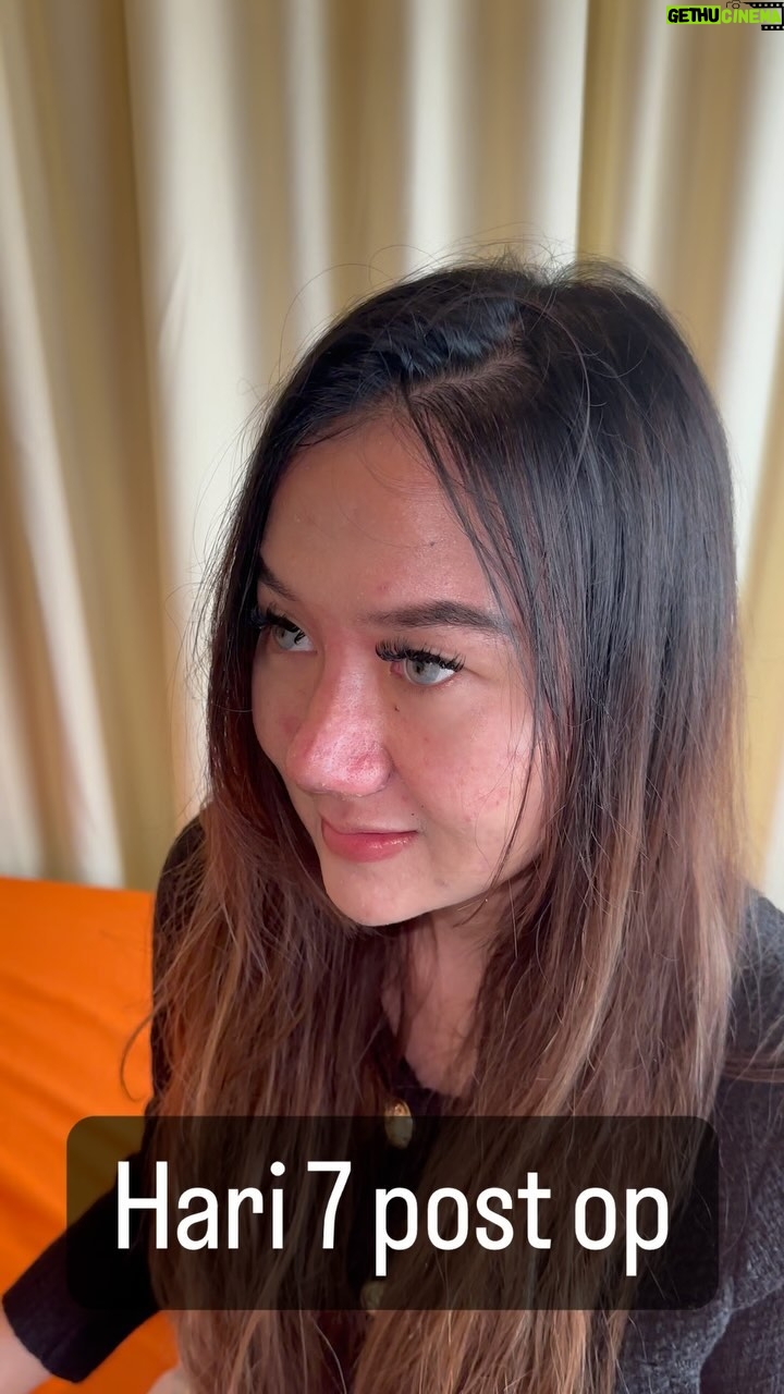 Tompi - 2.4K Likes - Hari ke 7 post Rhinoplasty iga, pada hidung yg bulbous (bahasa awamnya idung jambu) : utk membuat ramping tdk bs dengan hanya menipiskan jaringan lunaknya saja. Perlu adjustment pada susunan cartilage nya krn itu perlu iga sebagai bahan dasar nya