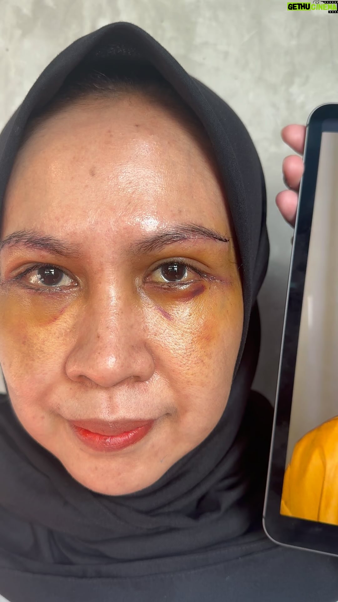 Tompi - 645 Likes - Tampilan op kantung mata dan browlift , hari ke 4. Bengkak dan memar termasuk sangat minimal . Aktifitas bebas sejak abis op
Jadi bs lansung mandi pake kacamat make up dll
Posisi tidur bebas
Utk hasil , ini Masih proses y
Biaaanya sebulan dah mulai enak dilihat
Final 3-6 bulan