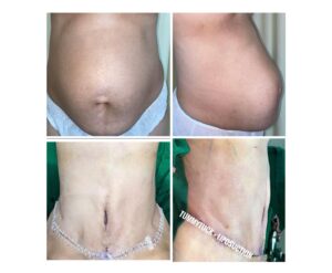 Tompi Instagram - Selama bulan juni, BEYOUTIFUL mempersembahkan paket khusus utk MOMMY MAKEOVER — TUMMYTUCK LIPOSUCTION (hemat hingga 30%)
BREAST AUGMENTATION-BREAST REDUCTION-BREAST LIGTING (hemat hingga 20%)

Silahkan BEYOUTIFUL T-SPACE BINTARO9 
telp 0811 8111 0558  0811 8111 0559 

BEYOUTIFUL PAKUBUWONO 
jl PAKUBUWONO VI no 5a jaksel 
 62 821-1303-5099  0217211025