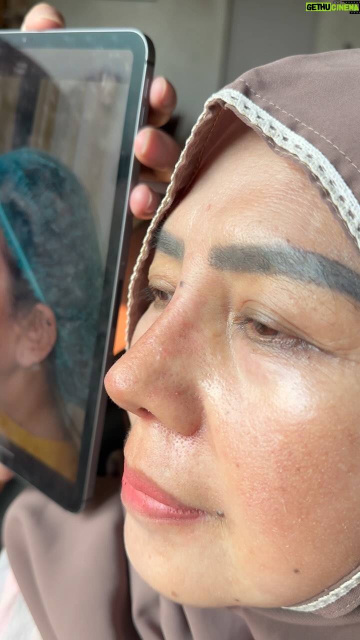 Tompi - 849 Likes - Post rhinoplasty Iga mggu ke 3