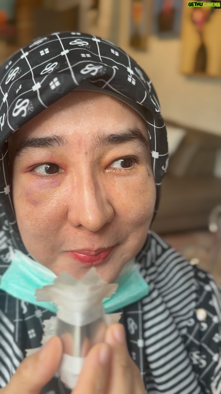 Tompi - 1.7K Likes - Ini adalah contoh case RHINOPLASTY FUNGSIONAL ; Pasien dengan keluhan hidung bengkok dan nafas terganggu. Perbaikan dengan meluruskan septum dan memperkuat struktur nya menggunakan tlg rawan iga.
Bonusnya: bentuk bs lbh estetik tp GOAL utamanya adalahnoerbaikan fungsi. Case seperti ini seharusnya bs menggunakan fasilitas asuransinya . Gangguan fungsi nafas ini bs membuat sering migrain/pusing/gampang lelah.
BEYOUTIFUL T-SPACE BINTARO9 telp 0811 8111 0558 0811 8111 0559 BEYOUTIFUL PAKUBUWONO jl PAKUBUWONO VI no 5a jaksel 62 821-1303-5099 0217211025