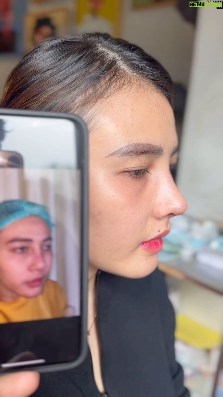 Tompi - 762 Likes - Kontrol 2 mggu post op rhino iga. Pasien dengan riwayat 2 x op sebelum dengan implant kombinasi tlg rawan telinga: miring dan asimetri nostril.