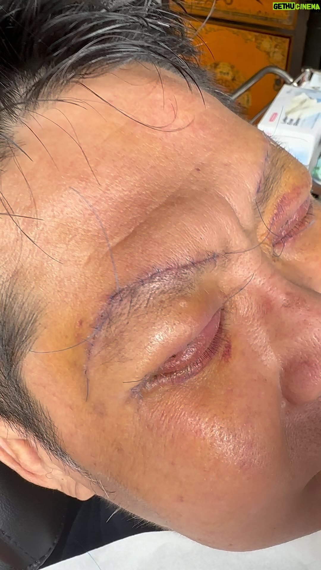Tompi - 1.7K Likes - Cabut jaitan abis op lipat mata atas , browlift dan kantung mata.. merdeka! Oh iya ini hari ke 4 post op, sejak abis op bs lansung mandi , cuci muka sabunan shampoan, makan bebas , posisi tidur bebas, aktifitas bebas , bs olahraga juga
Bengkak memar termasuk sangat minimal nih… padahal baru hari ke 4
Pasien cowok juga berhak loh ya ngerawat penampilan biar SEGAR terus