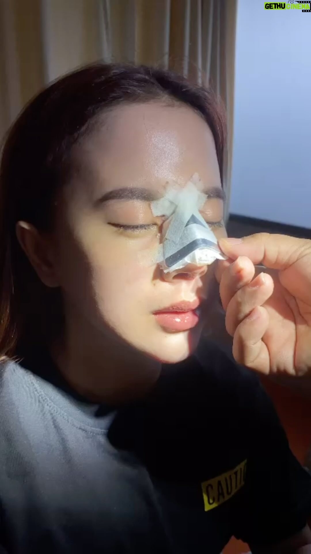 Tompi - 2.2K Likes - Hari ke 4 saatnya buka balutan hidung
Pasien post koreksi infeksi benang-filler hidung sebelumnya. Dilakukan 1 stage prosedur utk membersihkan dan rhinoplasty iga.