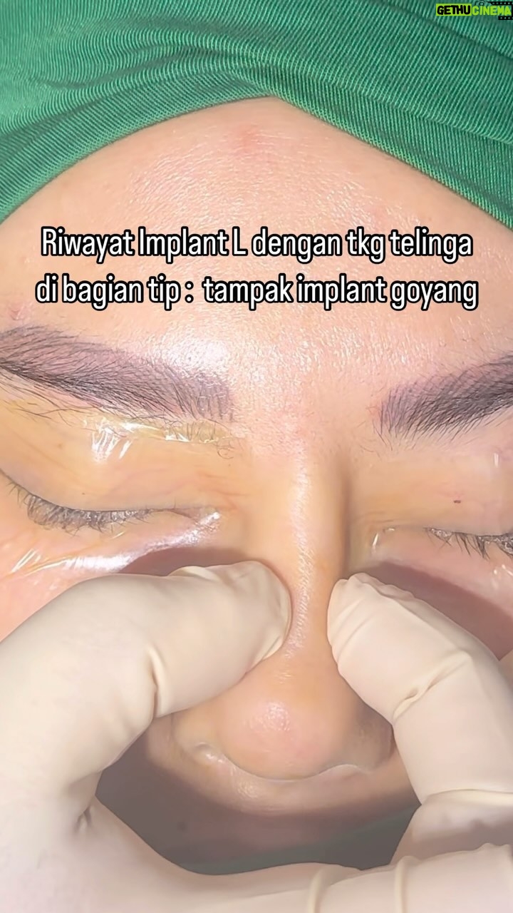 Tompi - 603 Likes - Riwayat L implant dengan tlg rawan telinga di tip. Pasien masih merasa tip bulet, batang goyang dan lubang blum simetri
Koreksi dengan tlg rawan iga
