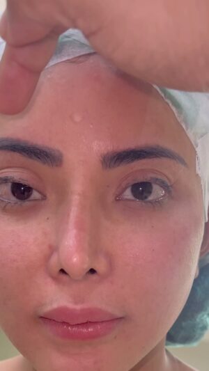 Tompi Instagram - Op Koreksi pada mata ptosis yg sudah pernah di op sebelumnya. Setelah tindakan pasien bs lansung mandi cuci muka. Aktifitas bebas senyamannya.  Bengkak memar biasanya minimal