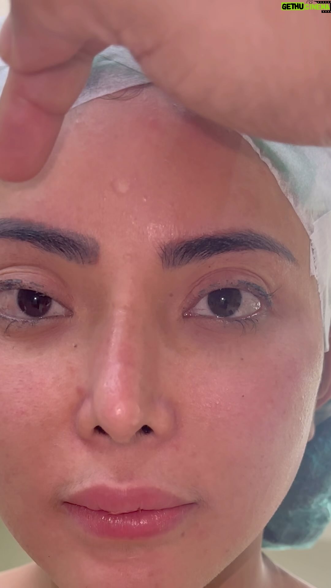 Tompi - 1.2K Likes - Op Koreksi pada mata ptosis yg sudah pernah di op sebelumnya. Setelah tindakan pasien bs lansung mandi cuci muka. Aktifitas bebas senyamannya. Bengkak memar biasanya minimal