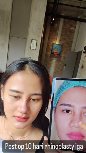 Tompi Instagram - Hari 10 post Rhinoplasty iga case ex filler benang