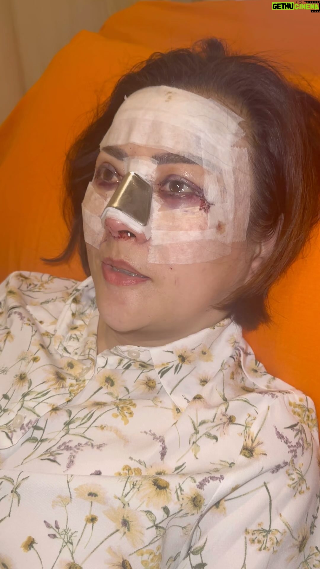 Tompi - 10.8K Likes - Op area wajah : mata hidung sekaligus. Bisa dengan bengkak memar minimal. Kita tunggu kontrol pertama ntar hr3 y