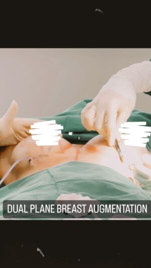 Tompi Instagram - Breast augmentation: prosedur koreksi ukuran payudara. Ada beberapa hal yg perlu diperhhatikan utk mendapatkan hasil yg estetik: posisi puting , ketebalan jaringan payudara, tlg dada dan ada tdknya skoliosis ( tlg belakang)
 Selanjutnya dibuatkan design utk menentukan ukuran implant yg dibutuhkan dan bentuk implantnya. Jd gak selalu harus bentuk tear drop implant (tergantung case) , dan perlu di tentukan perlu tidaknya lifting. Pada payudara yg sudah turun, Lifting mutlak perlu. Kl hanya dipasnag implant BESAR saja awalnya kliatan bagus namun setelah bbrp bulan akan semakin TURUN. 

Breast augmentation: dilakukan dengan sedasi ringan, tanpa nyeri. Pasien bs lansung Pulang dan aktifitas senyamannya. 

Nah utk konstasi lbh lanjut hub dr @risatoci @uthelumbuun @jei.nabila @dr.supit 

Beyoutiful at @t_spacebintaro