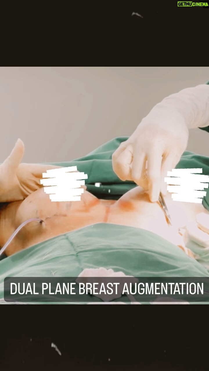 Tompi - 2.9K Likes - Breast augmentation: prosedur koreksi ukuran payudara. Ada beberapa hal yg perlu diperhhatikan utk mendapatkan hasil yg estetik: posisi puting , ketebalan jaringan payudara, tlg dada dan ada tdknya skoliosis ( tlg belakang)
Selanjutnya dibuatkan design utk menentukan ukuran implant yg dibutuhkan dan bentuk implantnya. Jd gak selalu harus bentuk tear drop implant (tergantung case) , dan perlu di tentukan perlu tidaknya lifting. Pada payudara yg sudah turun, Lifting mutlak perlu. Kl hanya dipasnag implant BESAR saja awalnya kliatan bagus namun setelah bbrp bulan akan semakin TURUN.
Breast augmentation: dilakukan dengan sedasi ringan, tanpa nyeri. Pasien bs lansung Pulang dan aktifitas senyamannya.
Nah utk konstasi lbh lanjut hub dr @risatoci @uthelumbuun @jei.nabila @dr.supit
Beyoutiful at @t_spacebintaro