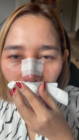 Tompi Instagram - Hr-8 post Rhinoplasty sekunder dengan Iga
Ini blum final, akan semakin ramping dalam 3-6 bulan