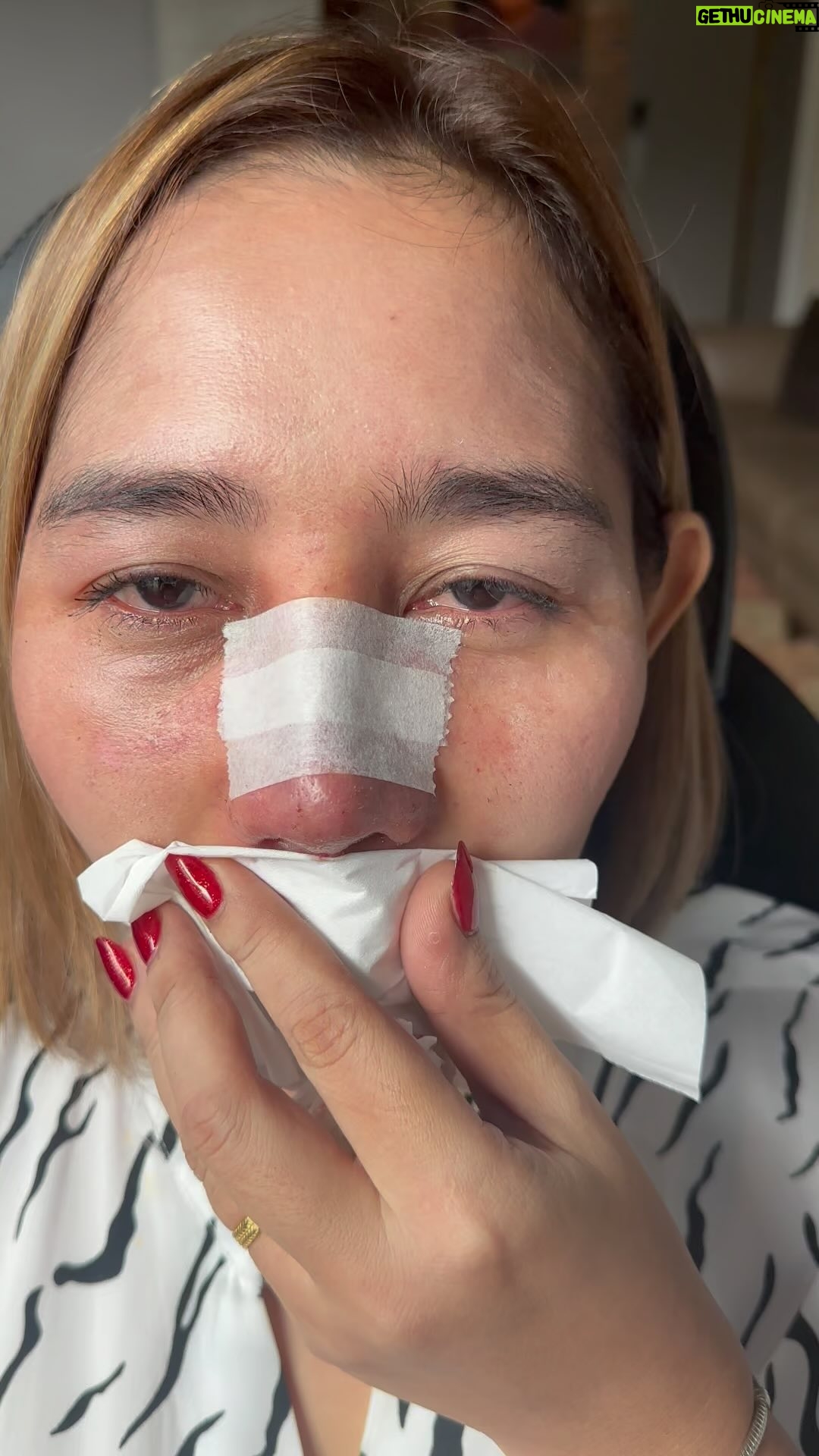 Tompi - 1.9K Likes - Hr-8 post Rhinoplasty sekunder dengan Iga
Ini blum final, akan semakin ramping dalam 3-6 bulan
