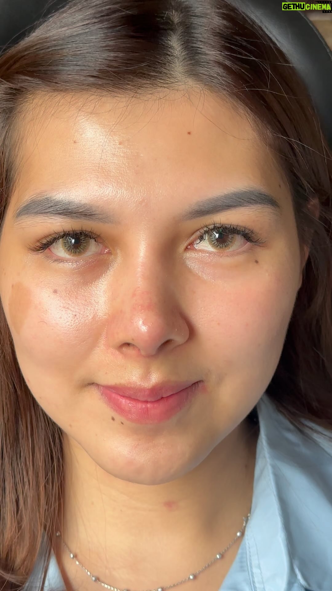 Tompi - 4.2K Likes - 1 bulan post op rhinoplasty iga
Masih ada sisa bengkak dikiiiiiit banget. Kl mau liat pre op nya ada di postingan sebelumnya